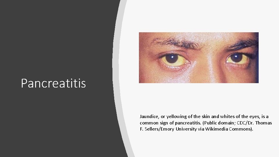 Pancreatitis Jaundice, or yellowing of the skin and whites of the eyes, is a