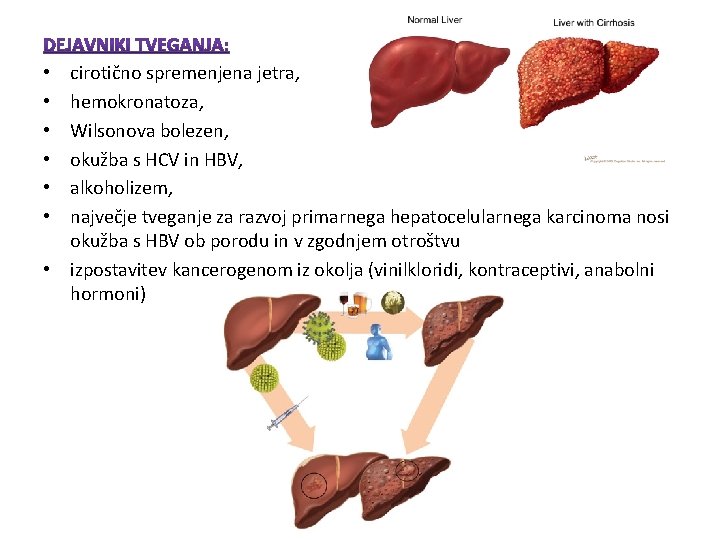cirotično spremenjena jetra, hemokronatoza, Wilsonova bolezen, okužba s HCV in HBV, alkoholizem, največje tveganje cirotično spremenjena jetra, hemokronatoza, Wilsonova bolezen, okužba s HCV in HBV, alkoholizem, največje tveganje