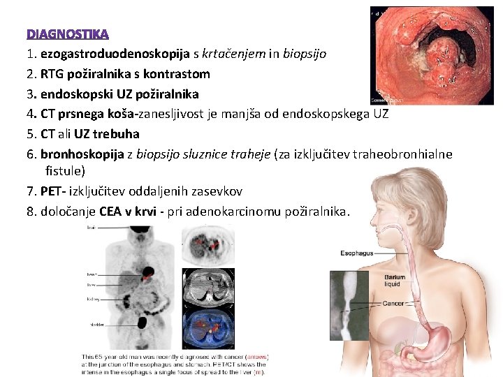 1. ezogastroduodenoskopija s krtačenjem in biopsijo 2. RTG požiralnika s kontrastom 3. endoskopski UZ 1. ezogastroduodenoskopija s krtačenjem in biopsijo 2. RTG požiralnika s kontrastom 3. endoskopski UZ