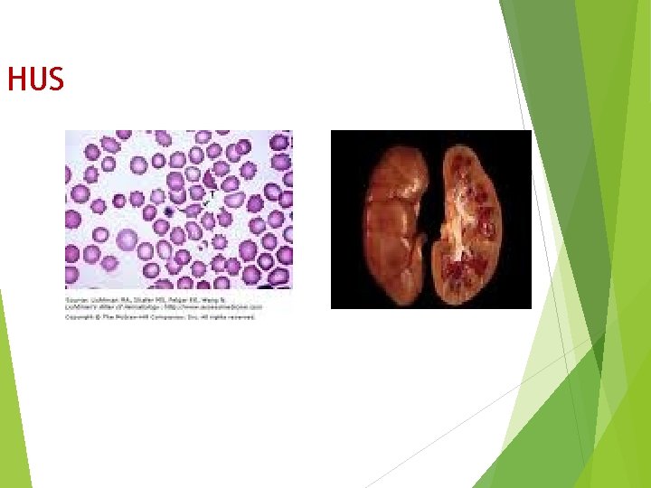 HUS 