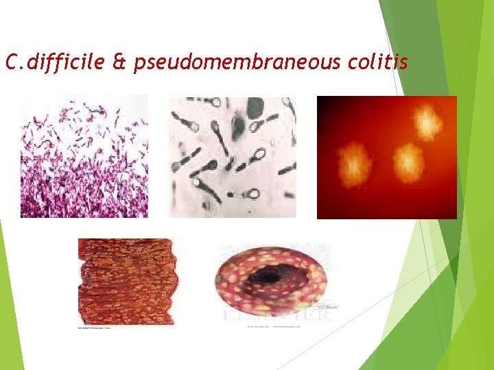 C. difficile & pseudomembraneous colitis 