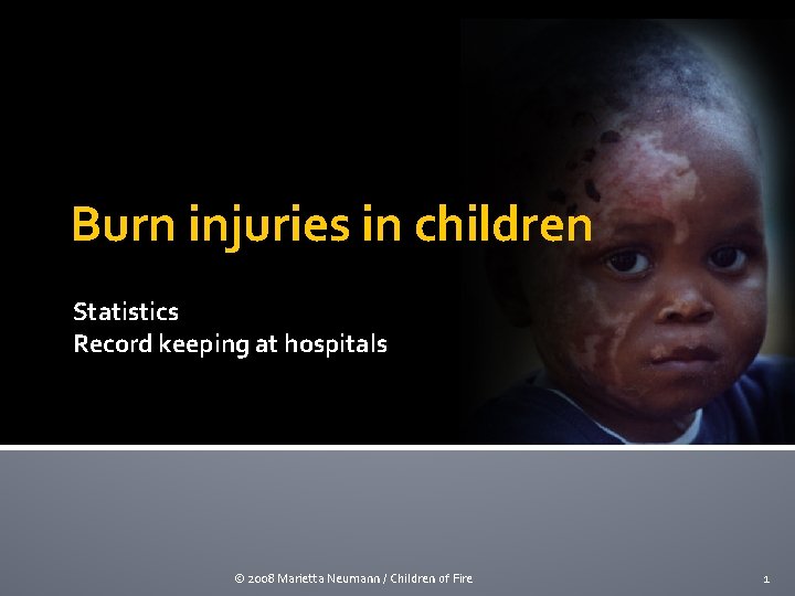 Burn injuries in children Statistics Record keeping at hospitals © 2008 Marietta Neumann /