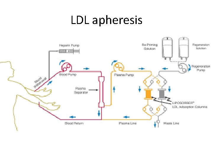 LDL apheresis 