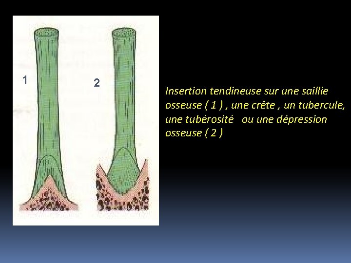1 2 Insertion tendineuse sur une saillie osseuse ( 1 ) , une crête