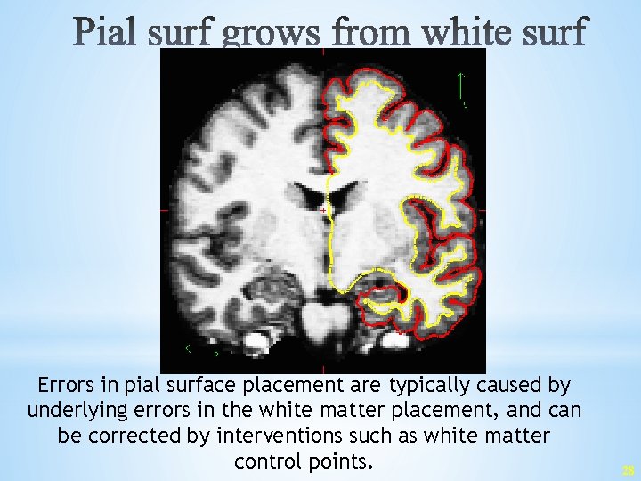 Errors in pial surface placement are typically caused by underlying errors in the white