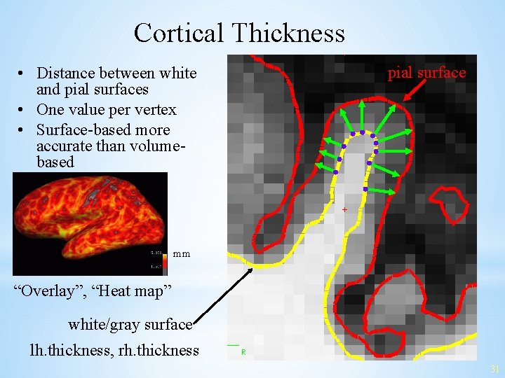 Cortical Thickness • Distance between white and pial surfaces • One value per vertex