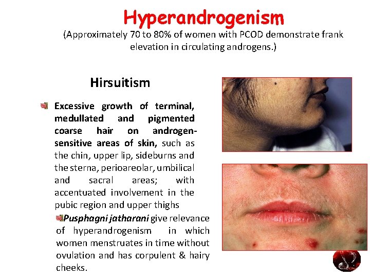 Hyperandrogenism (Approximately 70 to 80% of women with PCOD demonstrate frank elevation in circulating