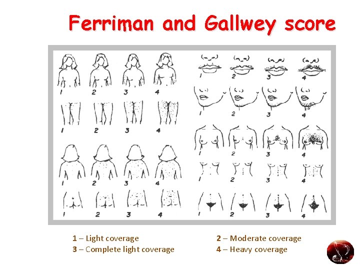 Ferriman and Gallwey score 1 – Light coverage 3 – Complete light coverage 2