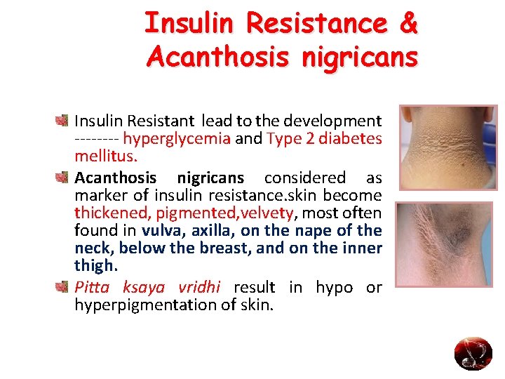 Insulin Resistance & Acanthosis nigricans Insulin Resistant lead to the development ---- hyperglycemia and