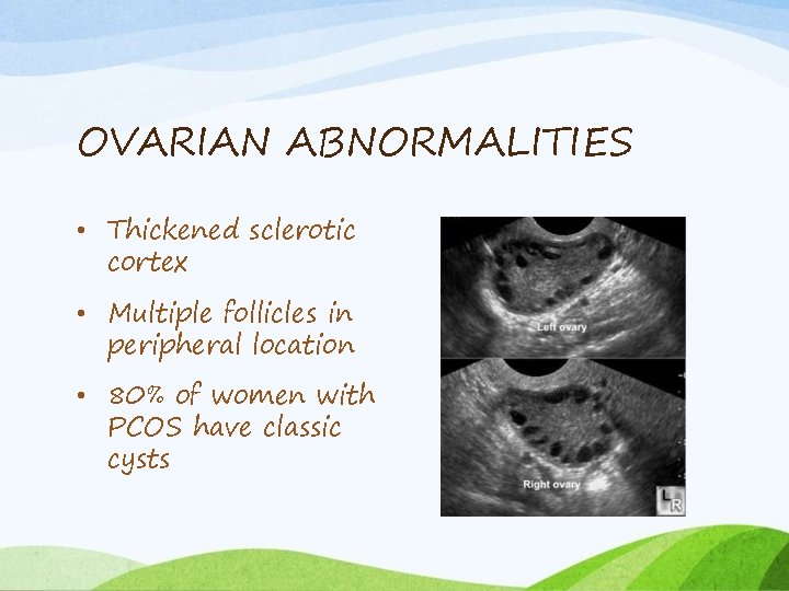 OVARIAN ABNORMALITIES • Thickened sclerotic cortex • Multiple follicles in peripheral location • 80%