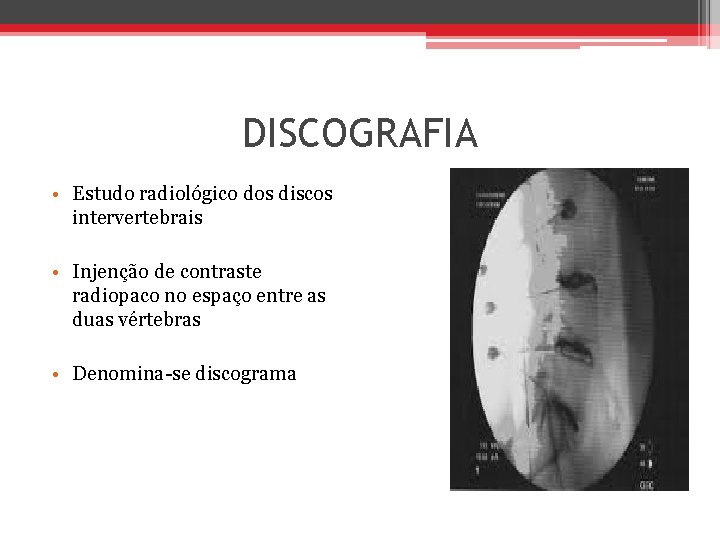 DISCOGRAFIA • Estudo radiológico dos discos intervertebrais • Injenção de contraste radiopaco no espaço