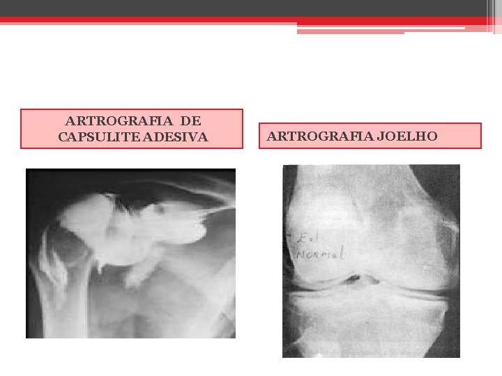 ARTROGRAFIA DE CAPSULITE ADESIVA ARTROGRAFIA JOELHO 