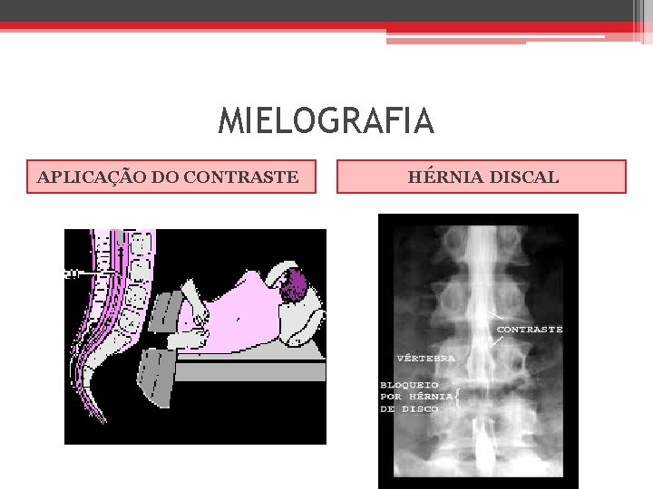 MIELOGRAFIA APLICAÇÃO DO CONTRASTE HÉRNIA DISCAL 