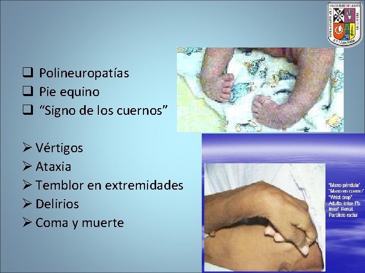 q Polineuropatías q Pie equino q “Signo de los cuernos” Ø Vértigos Ø Ataxia