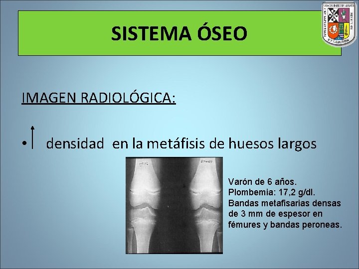 SISTEMA ÓSEO IMAGEN RADIOLÓGICA: • densidad en la metáfisis de huesos largos Varón de