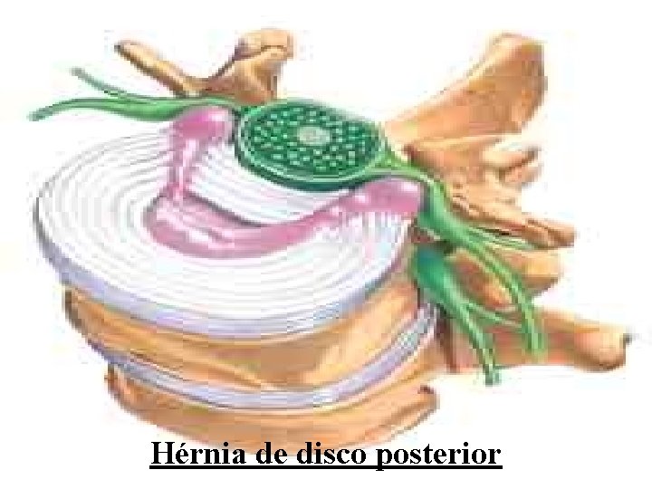 Hérnia de disco posterior 