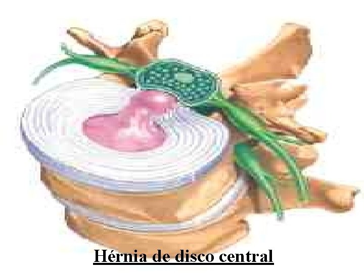 Hérnia de disco central 