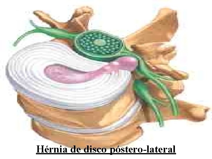 Hérnia de disco póstero-lateral 