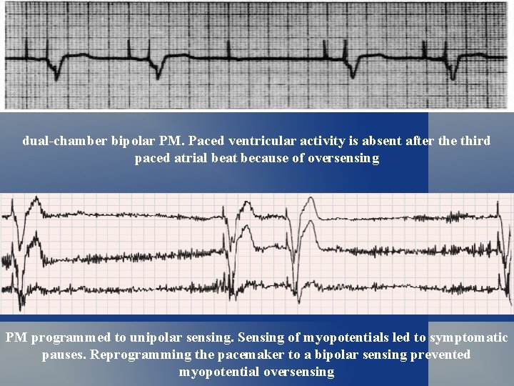 dual-chamber bipolar PM. Paced ventricular activity is absent after the third paced atrial beat