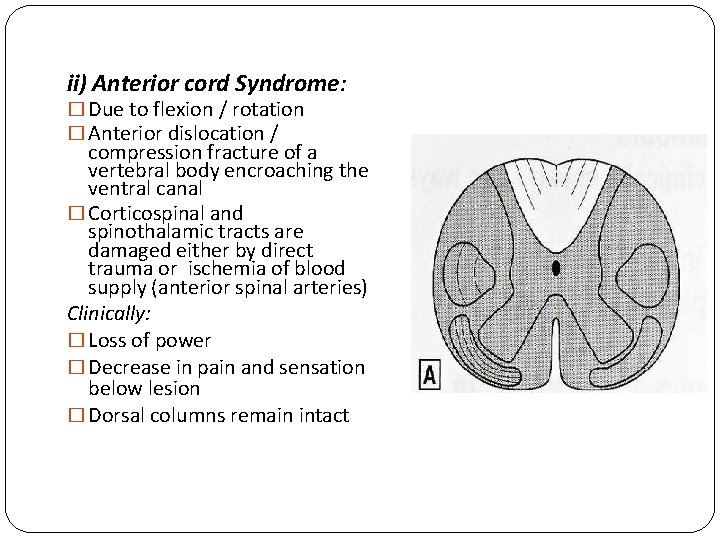 ii) Anterior cord Syndrome: � Due to flexion / rotation � Anterior dislocation /