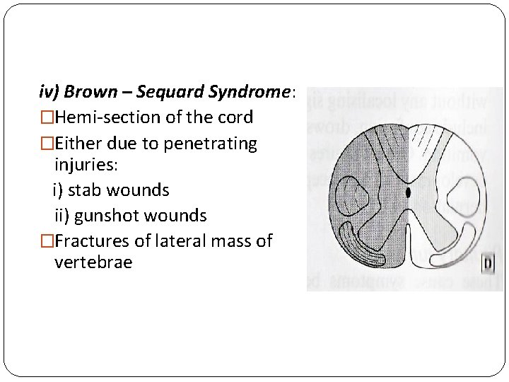 iv) Brown – Sequard Syndrome: �Hemi-section of the cord �Either due to penetrating injuries: