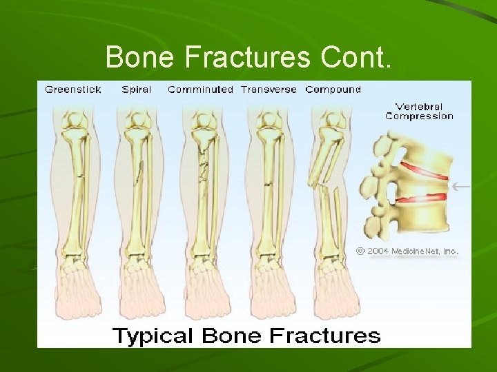 Bone Fractures Cont. 