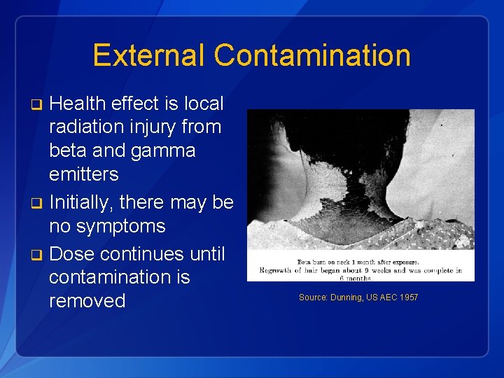 External Contamination Health effect is local radiation injury from beta and gamma emitters q