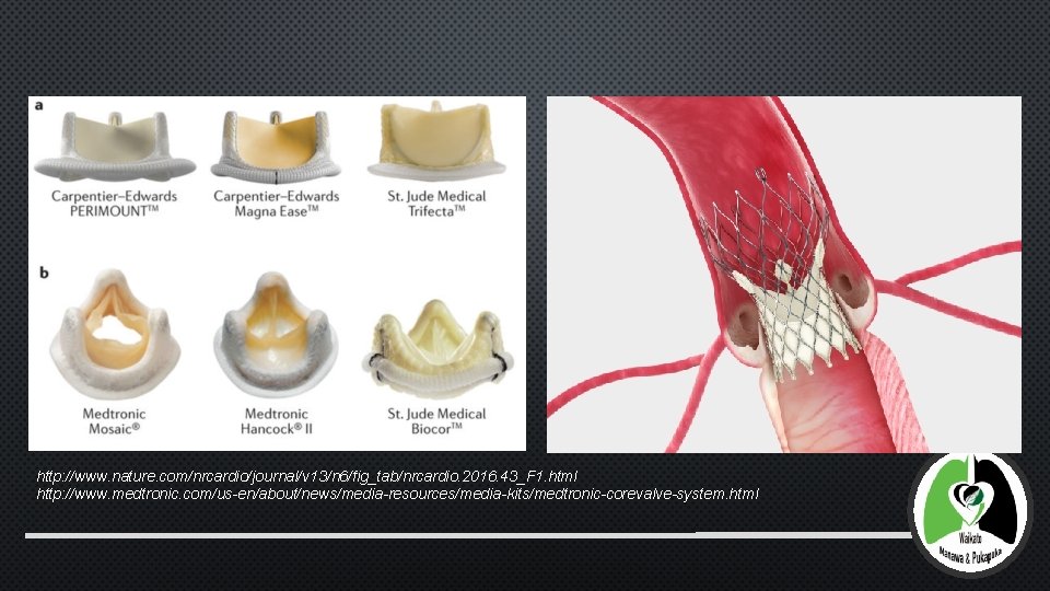 http: //www. nature. com/nrcardio/journal/v 13/n 6/fig_tab/nrcardio. 2016. 43_F 1. html http: //www. medtronic. com/us-en/about/news/media-resources/media-kits/medtronic-corevalve-system.
