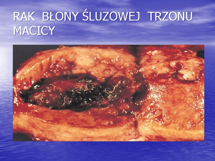 RAK BŁONY ŚLUZOWEJ TRZONU MACICY 