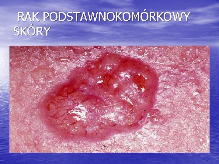 RAK PODSTAWNOKOMÓRKOWY SKÓRY 