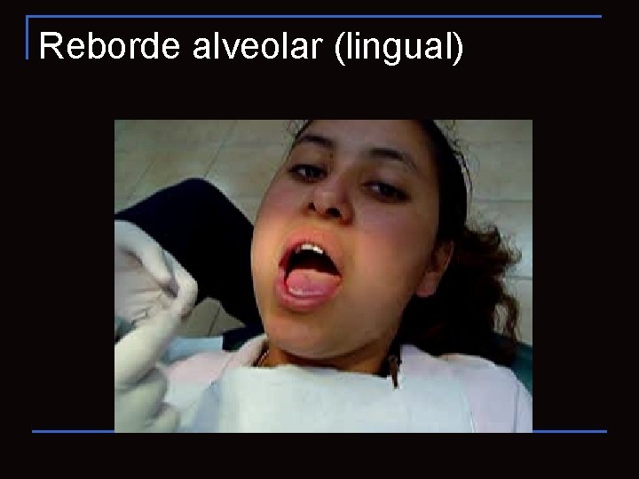 Reborde alveolar (lingual) 