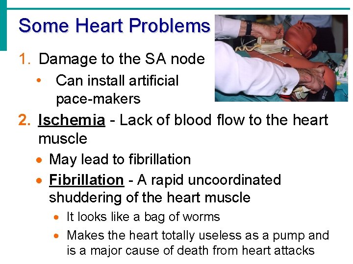 Some Heart Problems 1. Damage to the SA node • Can install artificial pace-makers Some Heart Problems 1. Damage to the SA node • Can install artificial pace-makers