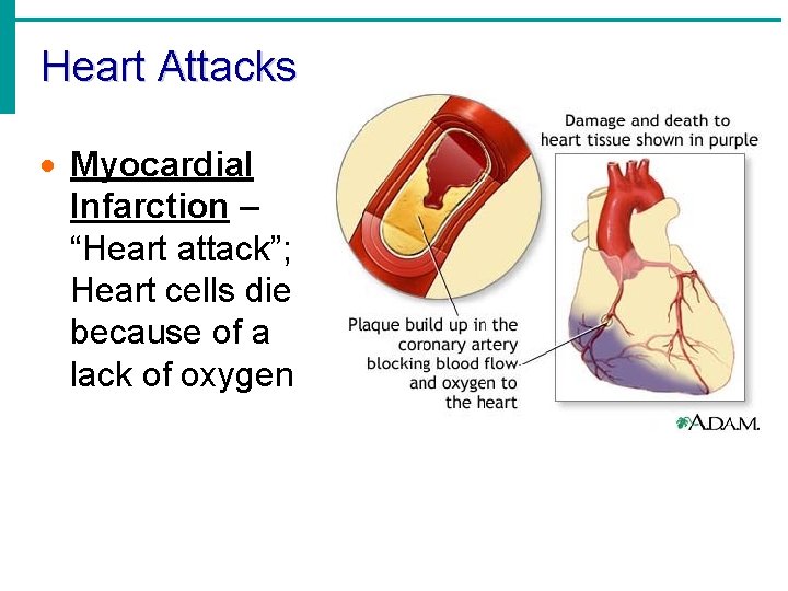 Heart Attacks · Myocardial Infarction – “Heart attack”; Heart cells die because of a Heart Attacks · Myocardial Infarction – “Heart attack”; Heart cells die because of a