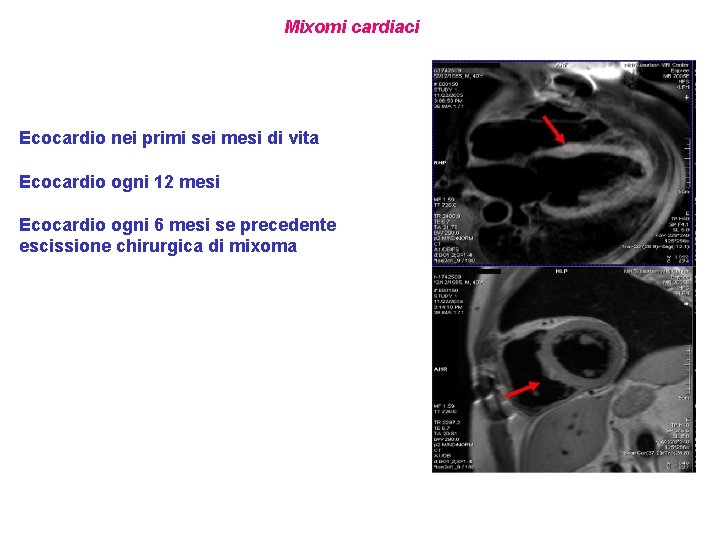 Mixomi cardiaci Ecocardio nei primi sei mesi di vita Ecocardio ogni 12 mesi Ecocardio