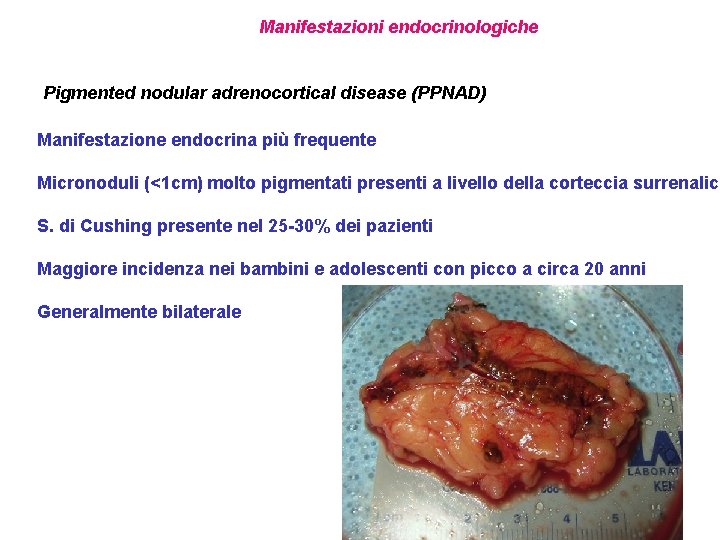 Manifestazioni endocrinologiche Pigmented nodular adrenocortical disease (PPNAD) Manifestazione endocrina più frequente Micronoduli (<1 cm)