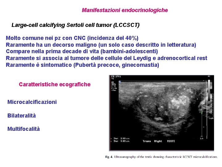 Manifestazioni endocrinologiche Large-cell calcifying Sertoli cell tumor (LCCSCT) Molto comune nei pz con CNC