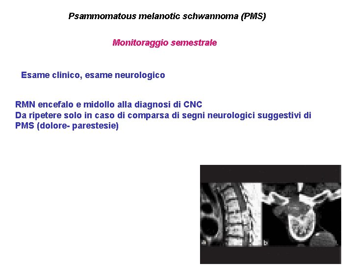 Psammomatous melanotic schwannoma (PMS) Monitoraggio semestrale Esame clinico, esame neurologico RMN encefalo e midollo