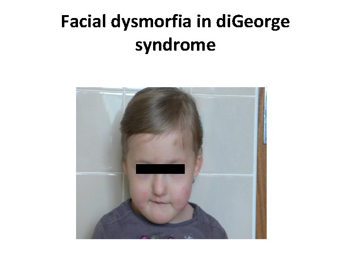 Facial dysmorfia in di. George syndrome 