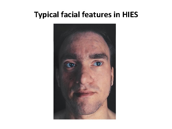 Typical facial features in HIES 