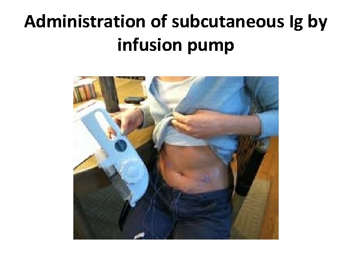 Administration of subcutaneous Ig by infusion pump 