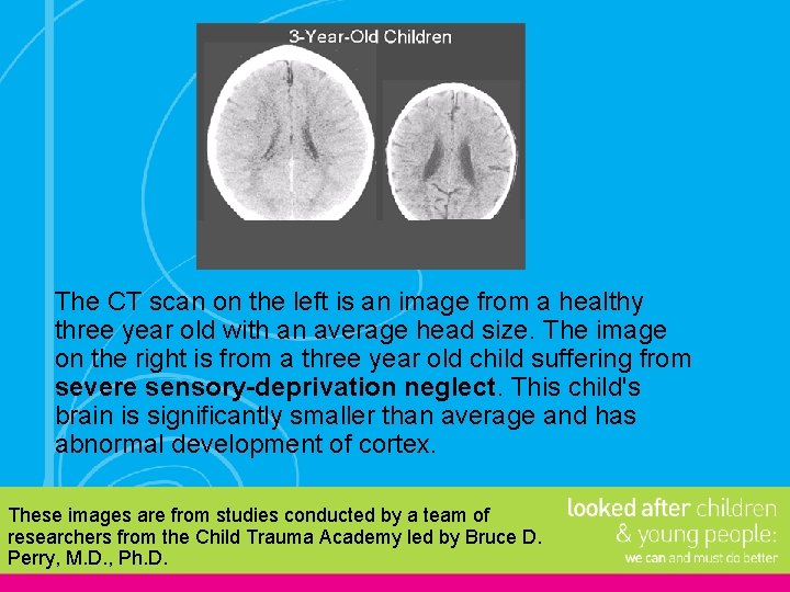 The CT scan on the left is an image from a healthy three year