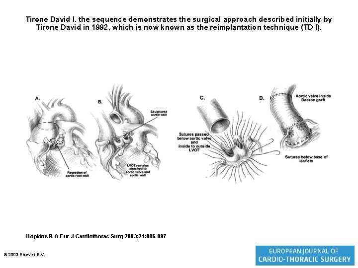 Tirone David I. the sequence demonstrates the surgical approach described initially by Tirone David