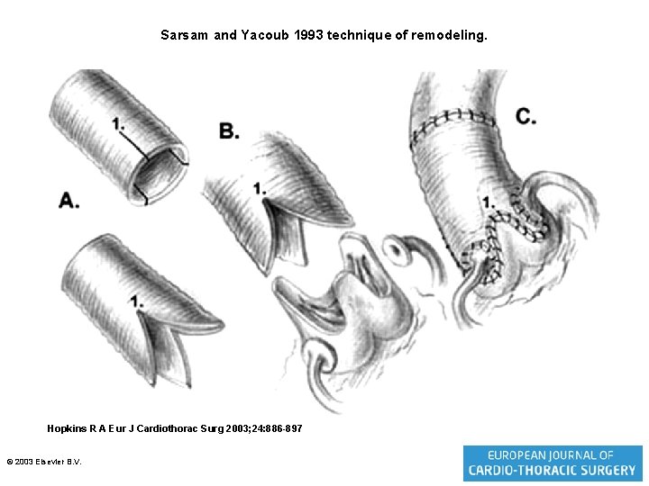 Sarsam and Yacoub 1993 technique of remodeling. Hopkins R A Eur J Cardiothorac Surg