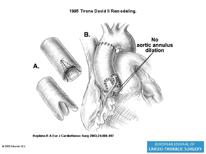 1995 Tirone David II Remodeling. Hopkins R A Eur J Cardiothorac Surg 2003; 24: