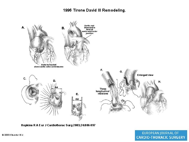 1996 Tirone David III Remodeling. Hopkins R A Eur J Cardiothorac Surg 2003; 24: