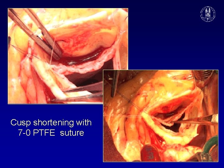 Cusp shortening with 7 -0 PTFE suture 