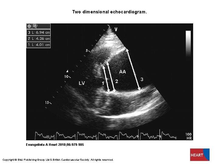 Two dimensional echocardiogram. Evangelista A Heart 2010; 96: 979 -985 Copyright © BMJ Publishing