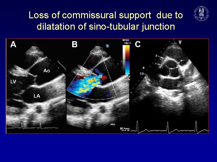 Loss of commissural support due to dilatation of sino-tubular junction 