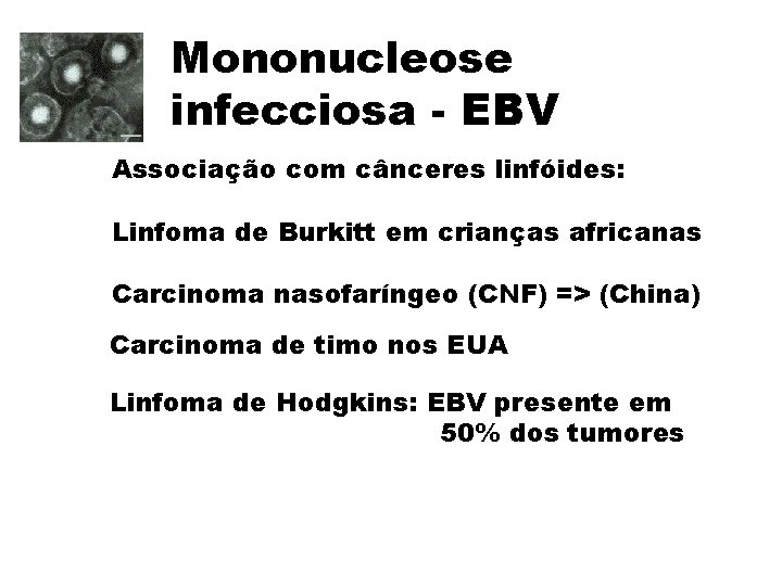 Mononucleose infecciosa - EBV Associação com cânceres linfóides: Linfoma de Burkitt em crianças africanas