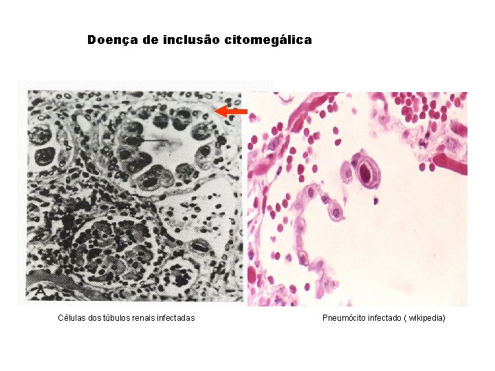 Doença de inclusão citomegálica Células dos túbulos renais infectadas Pneumócito infectado ( wikipedia) 